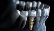 Contact with Dental Implants in Penrith 