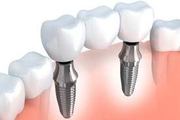  All-On-4 Dental Implants Sydney | Sedation Dentist Penrith 