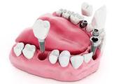   All-On-4 Dental Implants in Penrith | Sedation Dentistry in Blacktow