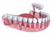 Dental Implants Dentistry in Penrith | All-on-4 Implants Dentistry
