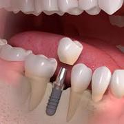   All-on-4 Dental Implants Dentistry | Sedation Cosmetic Surgery 