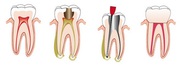 Root Canal Treatment Sydney | Cost & Treatment Procedure 