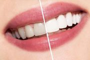 Professional Teeth Whitening In NSW | Shiny Brighter Smiles | Get Emer