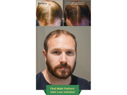 Consult our trichologists for best hair regrowth treatment in Sydney