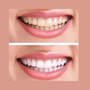 Best Teeth Whitening Treatment